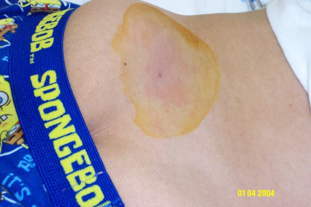 Bone Marrow Aspiration Site